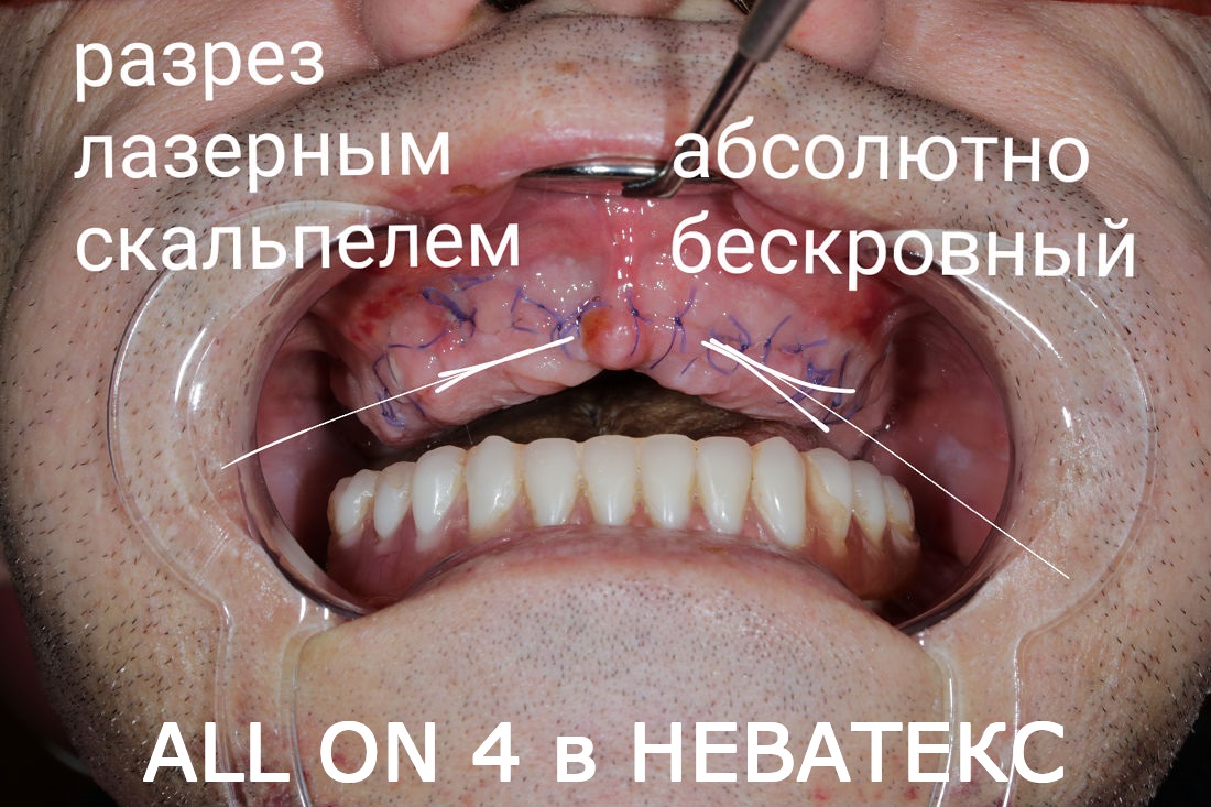 Операция Все зубы на четырех имплантах зубы на четырех имплантах